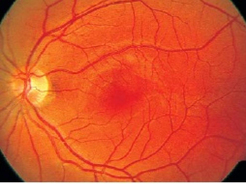 Esta novedosa técnica de neuroimagen se conoce como 'ventana al cerebro' y puede servir para un rápido diagnóstico de la esquizofrenia.
