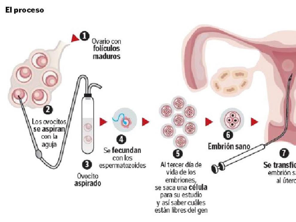 La técnica de selección de embriones por fecundación in vitro mediante el diagnóstico genético preimplantacional.