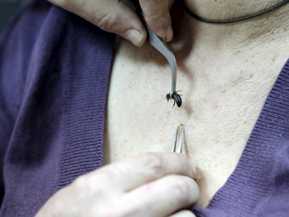 Con la pinza con la que aprisiona la abeja en una mano y otra pinza libre en la otra, el terapeuta acerca el himenóptero a la zona a tratar.