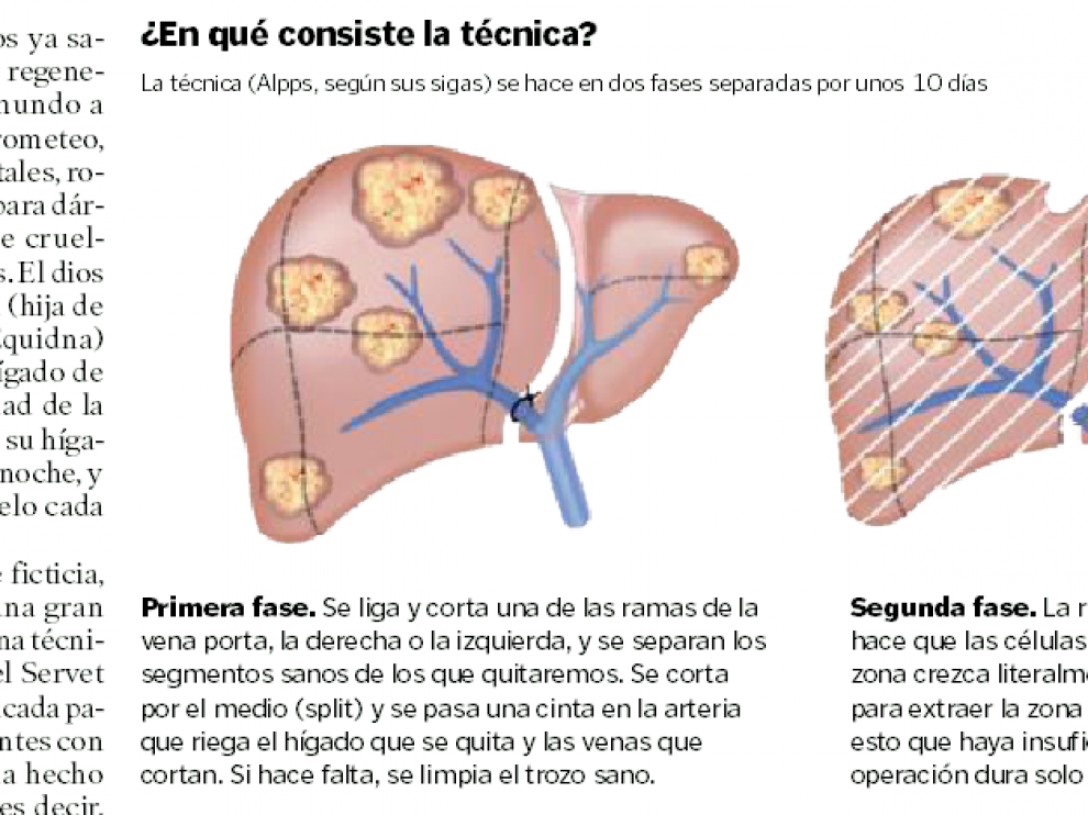 Pronostico vida higado metastasis
