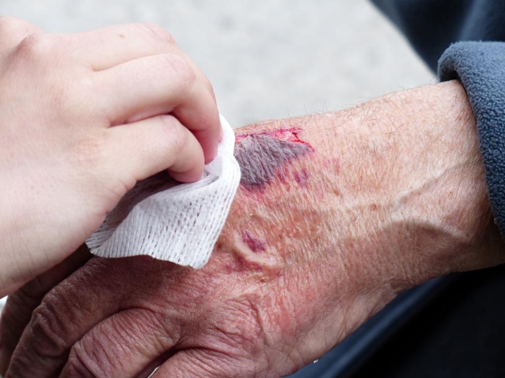 Resultado de imagen para heridas cronicas
