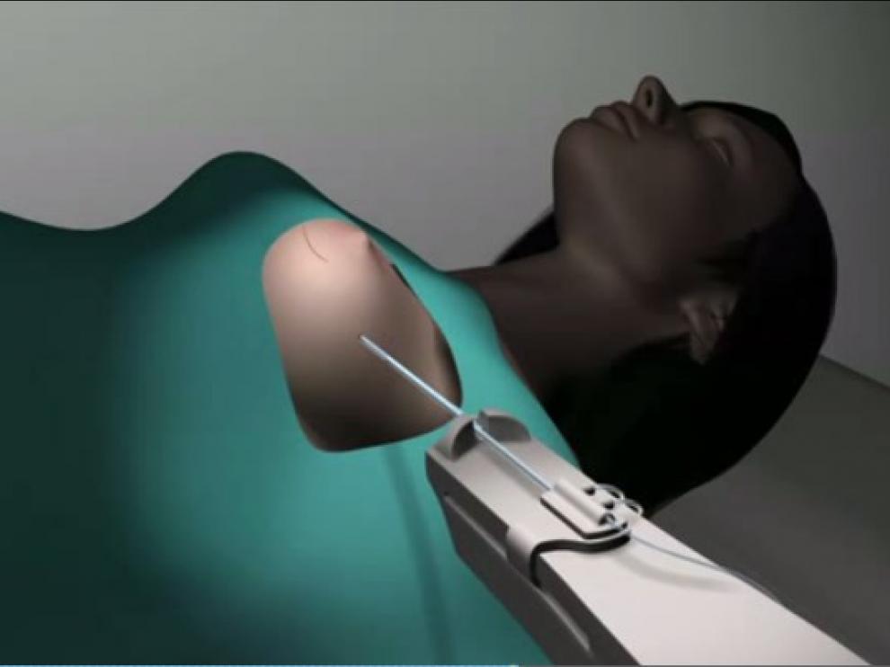 Recreación en 3D de una paciente, sometiéndose a un tratamiento de radioterapia contra el cáncer de mama.