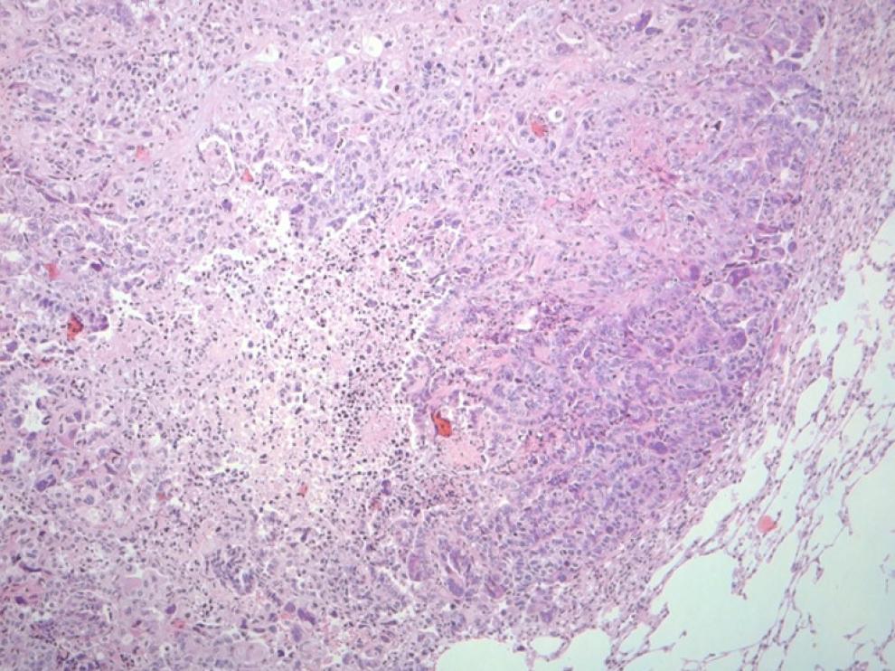 Tejido tumoral procedente de un ratón con cáncer de pulmón.