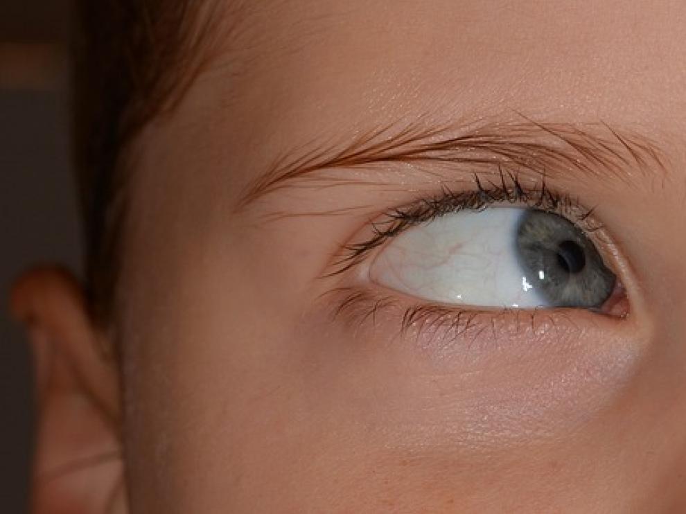 El estrabismo es un defecto visual que consiste en la pérdida de paralelismo de los ojos y es una de las complicaciones más frecuentes en niños pequeños.