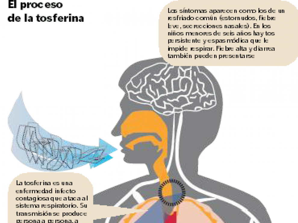 Proceso de la tosferina