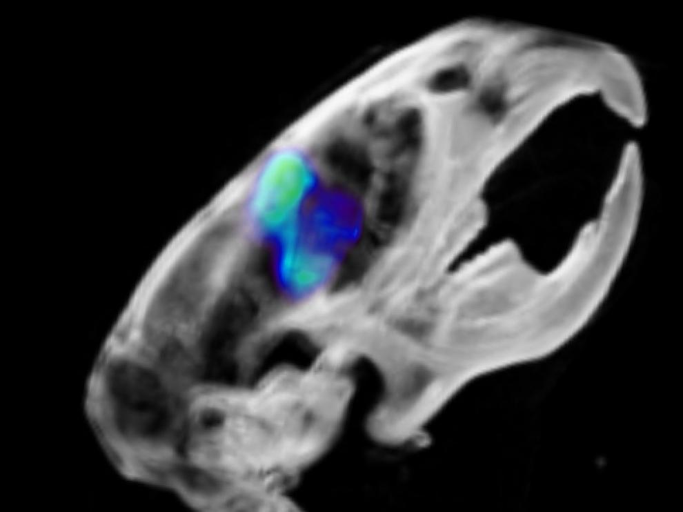 Punto sensible en el tumor cerebral