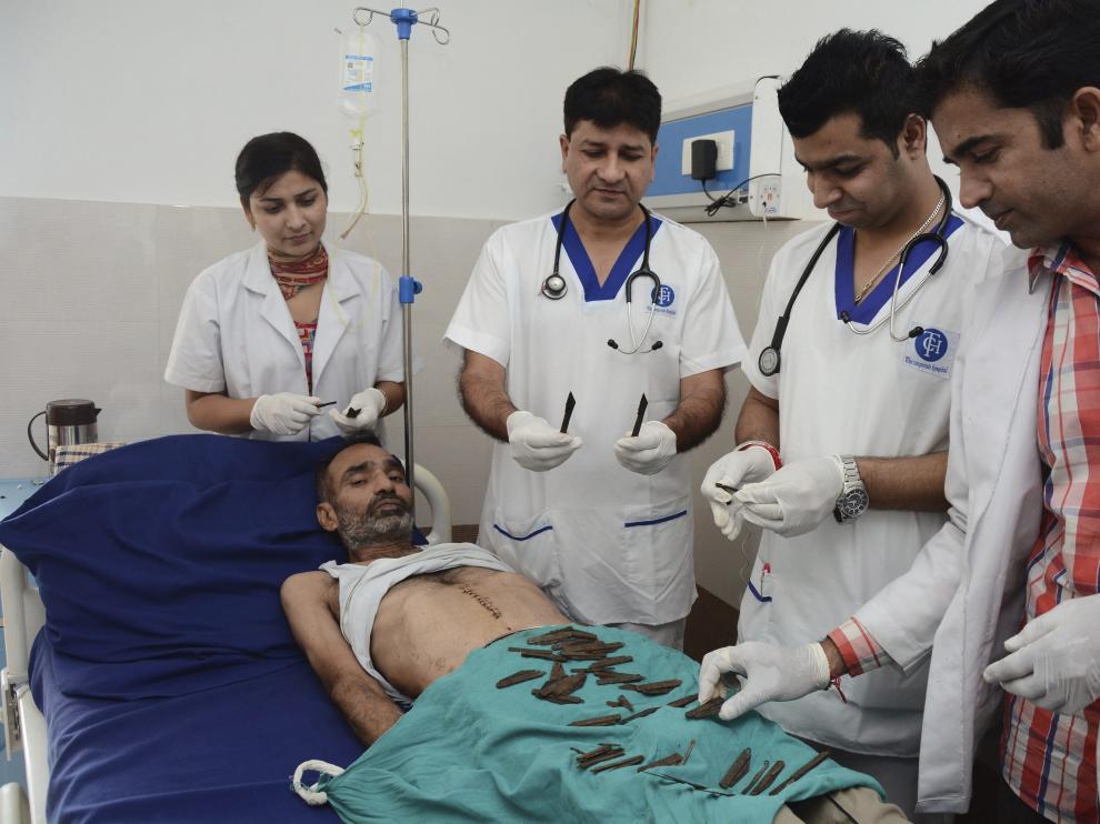 Acude al médico con dolor de estómago y le extraen 40 cuchillos