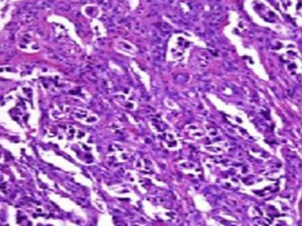 Vista microscópica de un cáncer de pulmón diagnosticado con el test epigenético.