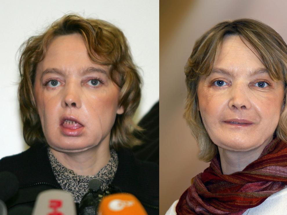 Imagen de archivo de Isabelle Dinoire antes y después de la operción