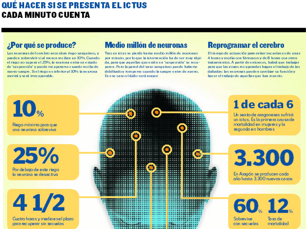 Qué es el ictus