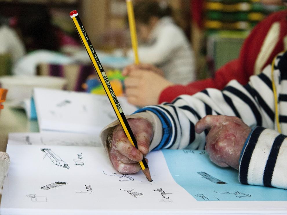 Imagen facilitada por la Asocición de Epidermólisis Bullosa Hereditaria.