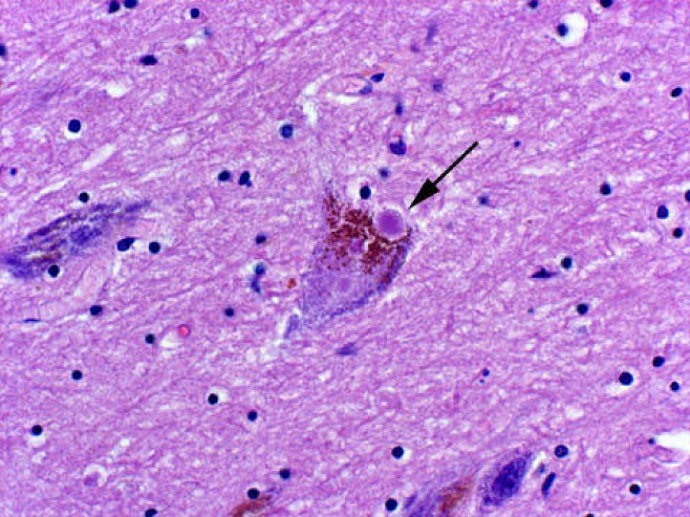 Una neurona con cuerpos de Lewy, las estructuras neurotóxicas características de un cerebro con párkinson