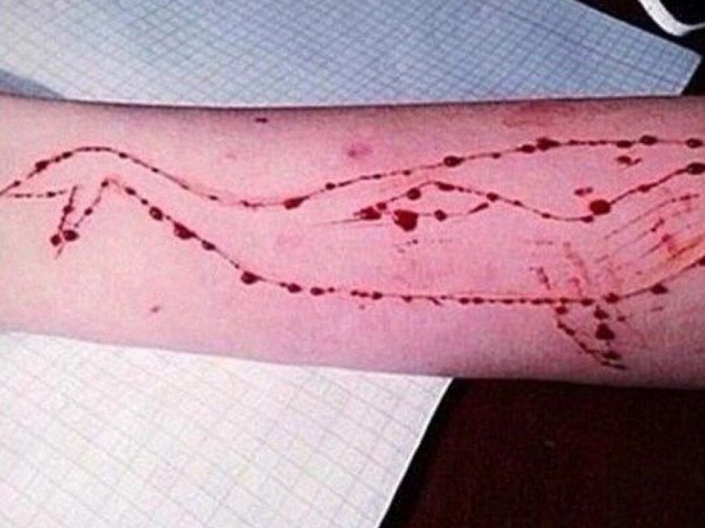 Escarificación de una ballena en el brazo de una adolescente retada por el juego de la 'ballena azul'.