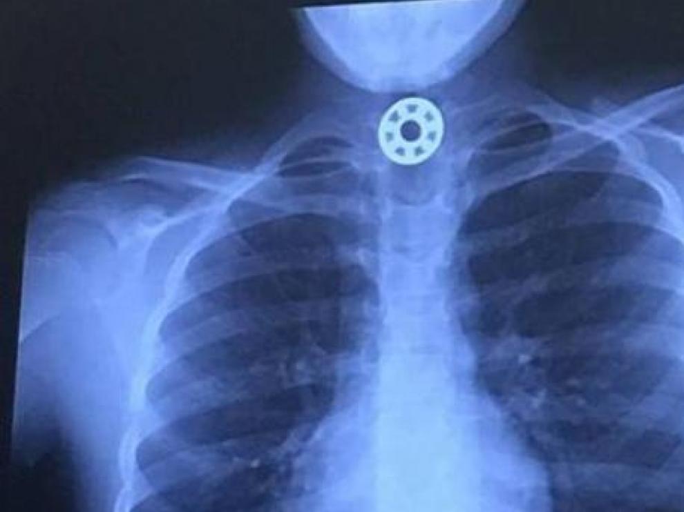 Una niña de 3 años, a punto de asfixiarse al tragarse un 'spinner'.