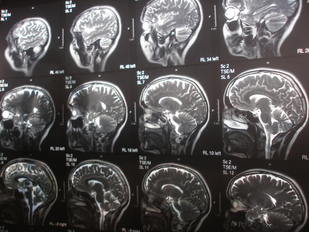 La práctica de ejercicio físico puede mantener a raya el deterioro cerebral