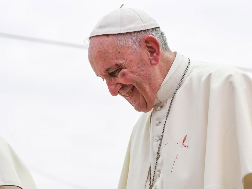 El pequeño golpe en la cara del papa Francisco le dejó la zona de la ceja y el pómulo visiblemente amoratada.