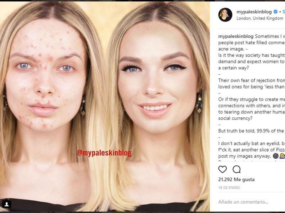 Em Ford es una 'youtuber' británica que comparte sus 'selfies' sin maquillar de manera que se ve su acné.