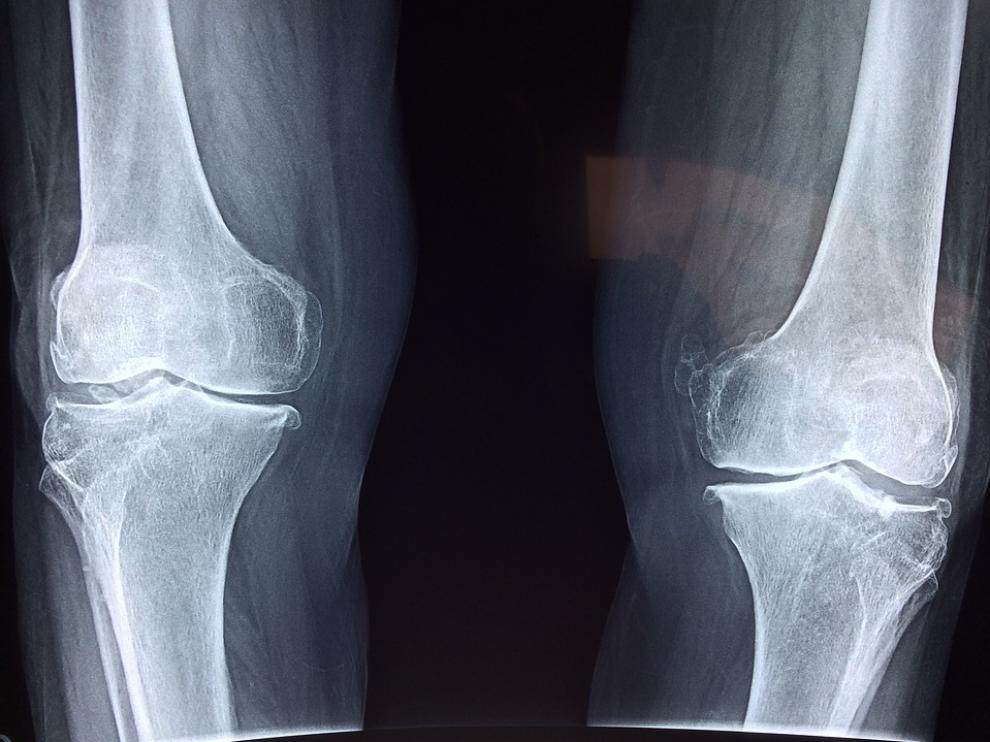 La fragilidad ósea raramente se detecta antes de la primera fractura.