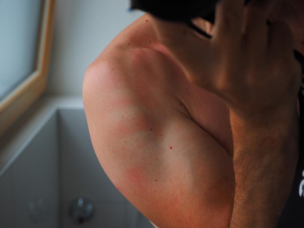 Utilizar crema solar es indispensable para evitar estas molestas irritaciones.