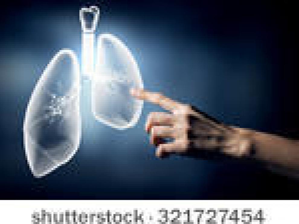 Descubren el motivo por el que la inmunoterapia es eficaz en algunos tipos de cáncer de pulmón