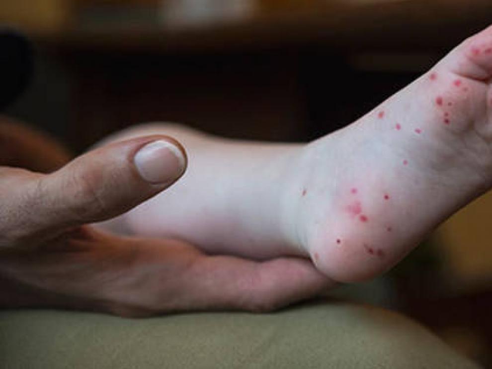Este síndrome provoca la aparición de mpollas en manos, pies y nalgas.
