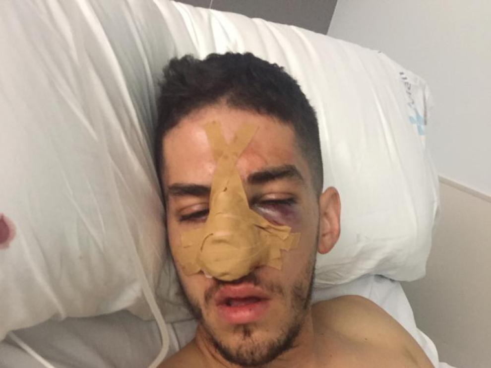 El jugador del Miralbueno lesionado tuvo que pasar por el quirófano al sufrir fractura facial y nasal.