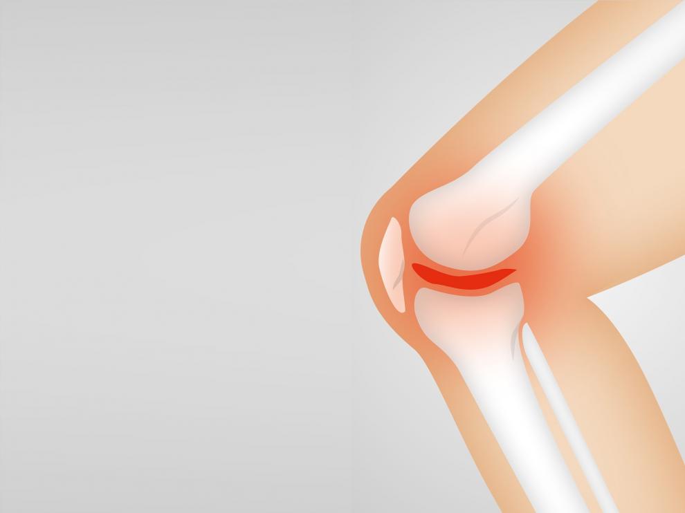La artritis provoca que la membrana sinovial que protege y lubrica las articulaciones se inflame y cause dolor e hinchazón
