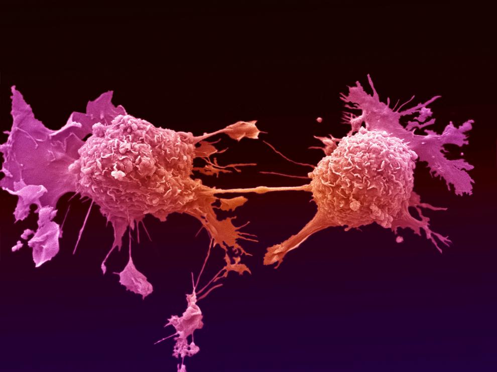 Células de cáncer de pulmón dividiéndose, unidas por un delgado hilo de citoplasma