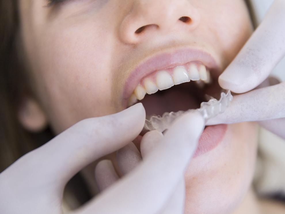 La ortodoncia transparente ha ganado popularidad en los últimos años y es igual de efectiva que la de 'brackets'.