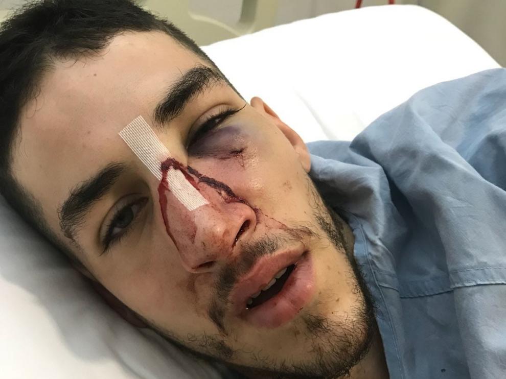 El jugador del C. D. Miralbueno tuvo que ser operado por una fractura nasal y precisó de implantes de titanio en el pómulo.