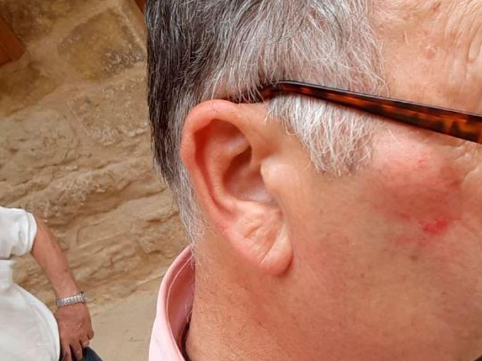 Rodrigo Brenchat muestra la lesión causada por el puñetazo del alcalde