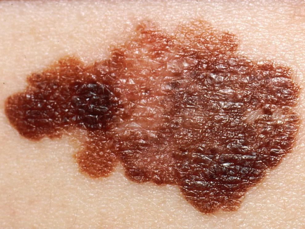 La genética y la exposición solar excesiva y repetitiva son factores que inciden en el desarrollo del melanoma, un tipo de cáncer de piel.