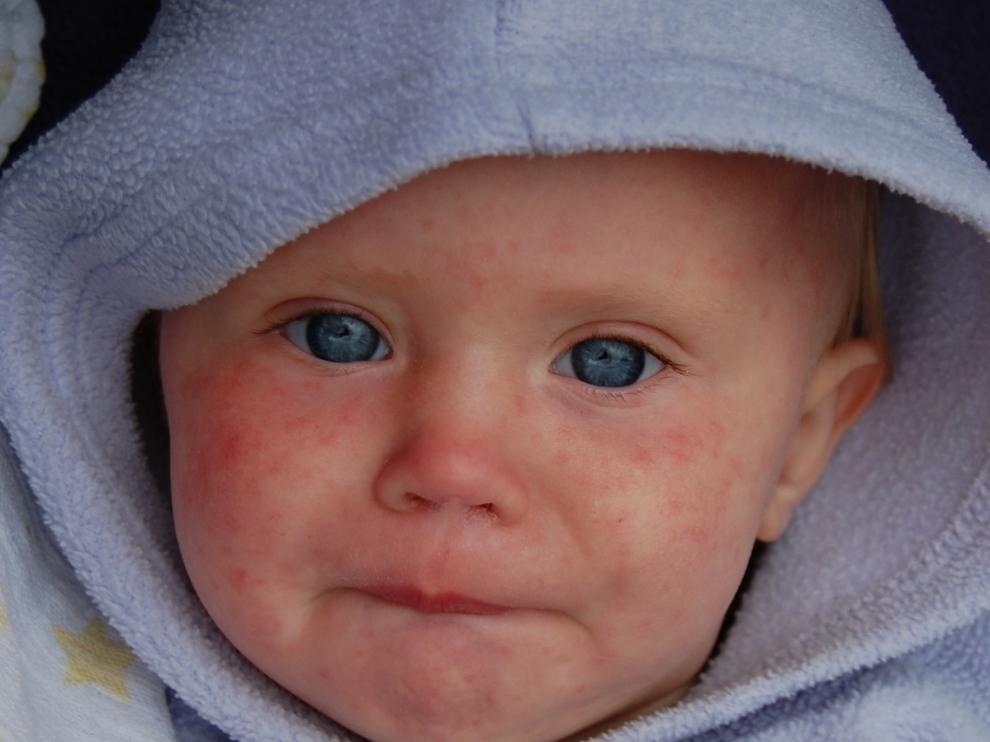 Unos días después de que suba la fiebre, se produce una erupción rojiza en la piel que comienza en la cara.