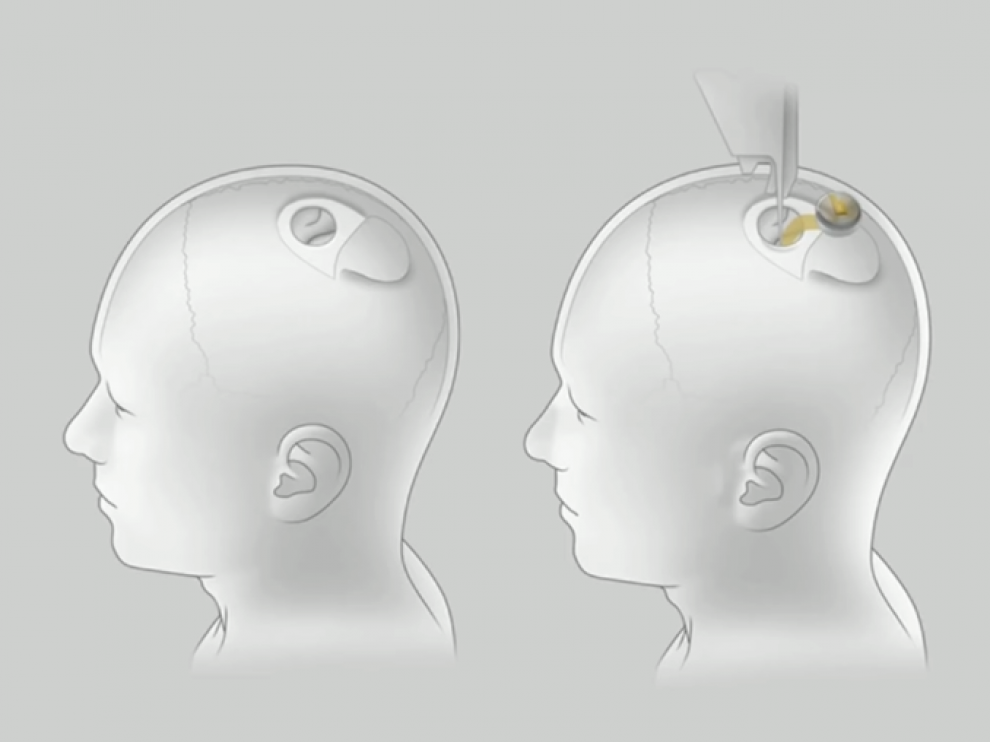 Han probado con éxito en cerdos un chip que implantado en el cráneo permite medir la actividad cerebral