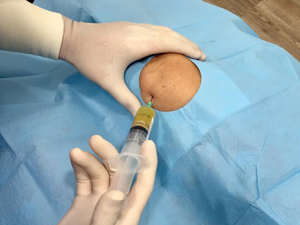 La artrosis de rodilla puede mejorar sus síntomas gracias a la Medicina Regenerativa.