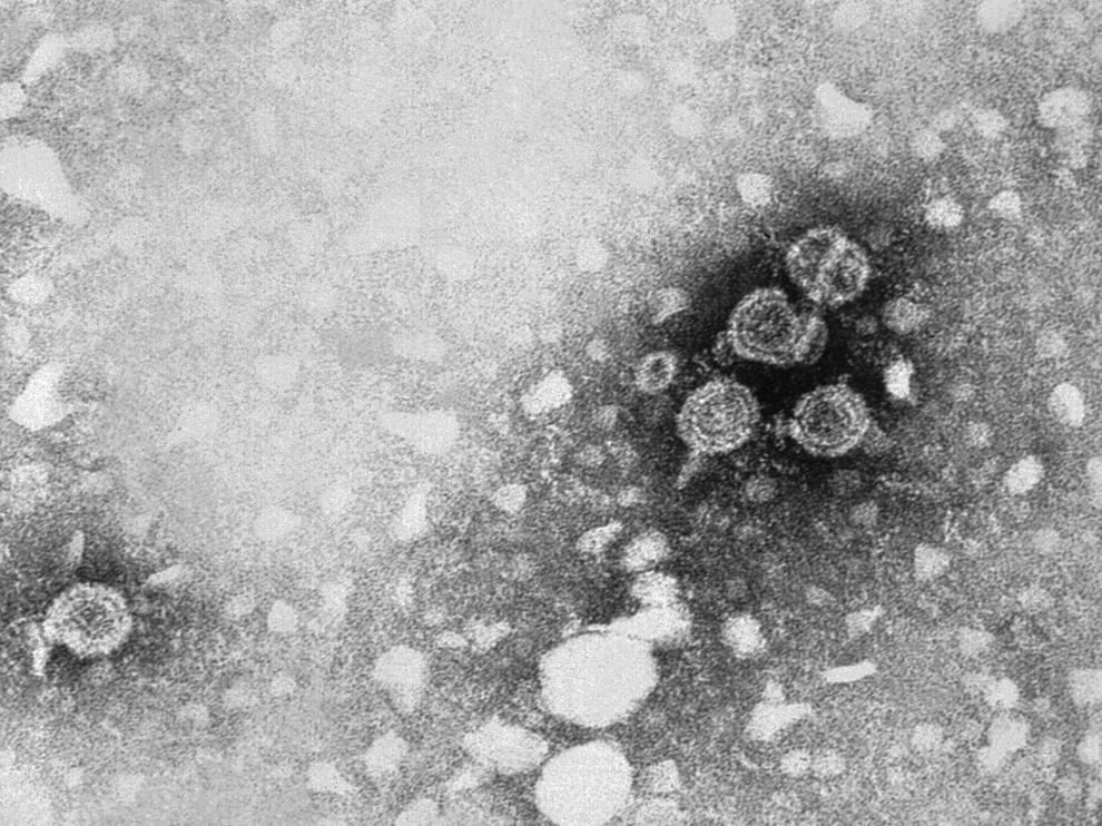 El virus de la hepatitis B, visto al microscopio electrónico.