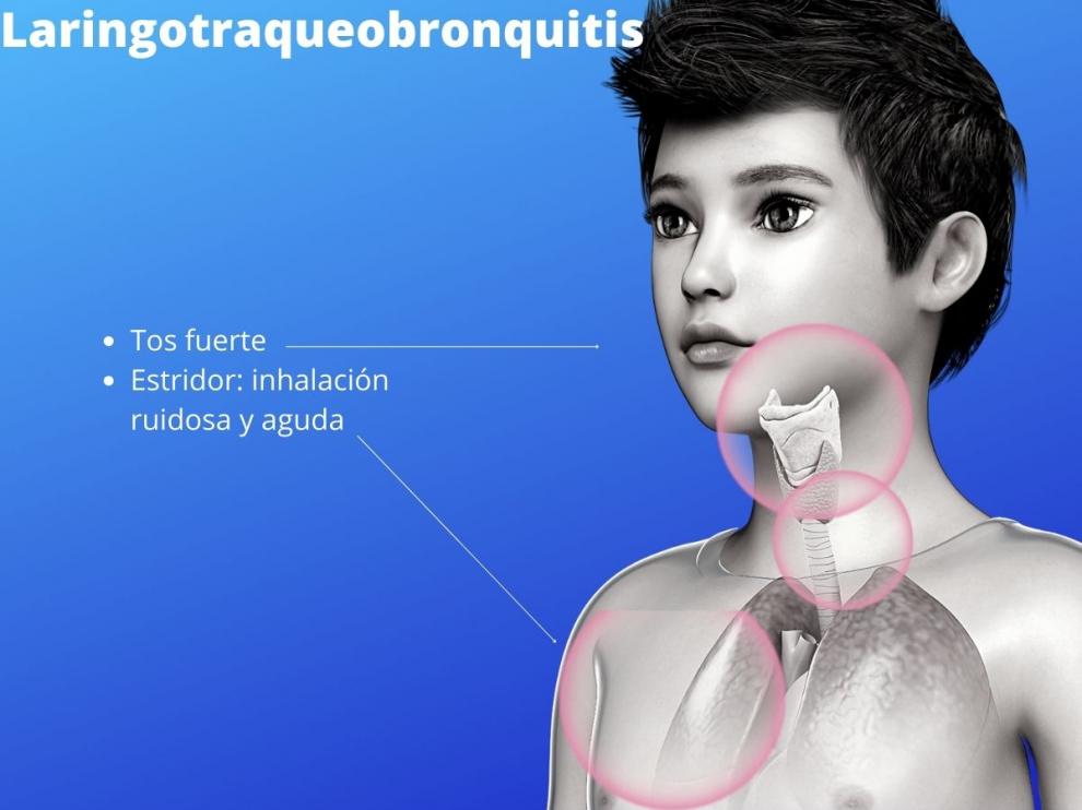 Laringotraqueobronquitis o crup, nuevo síntoma de la covid.