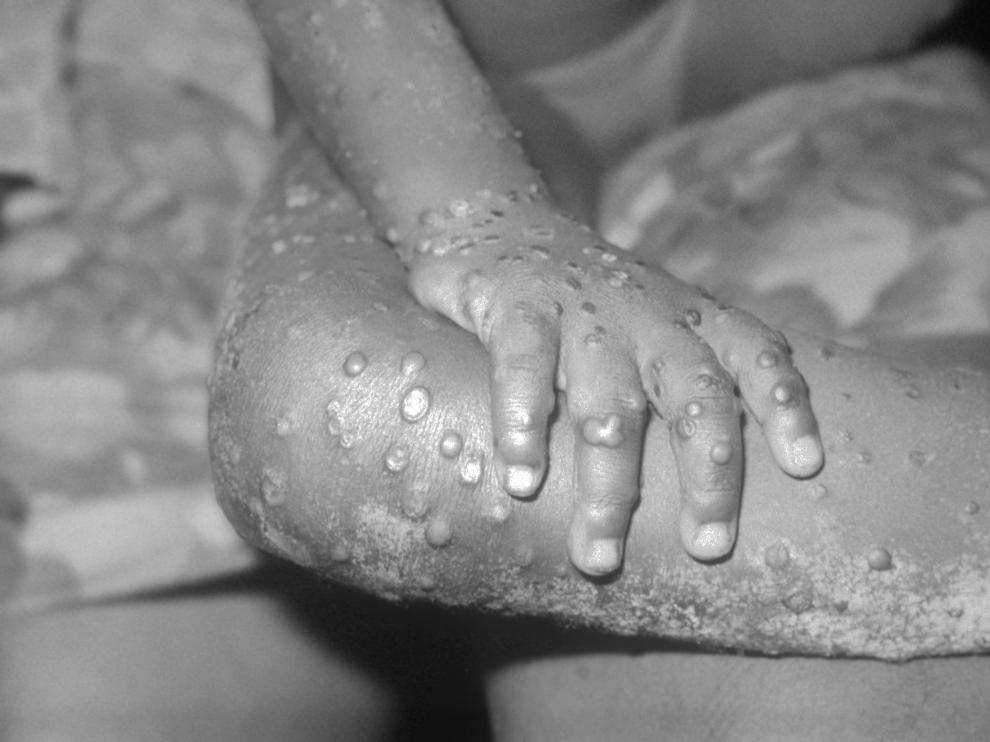 El mayor riesgo de contagio se da entre quienes tienen contacto físico cercano con alguien infectado y con síntomas. Human infection with monkeypox-like virus in 4 year-old female, Bondua, Grand Gedeh County, Liberia. Infection was caused by a pox virus of the vaccinea, variola, monkeypox type. 1971 tray #26, B71-990