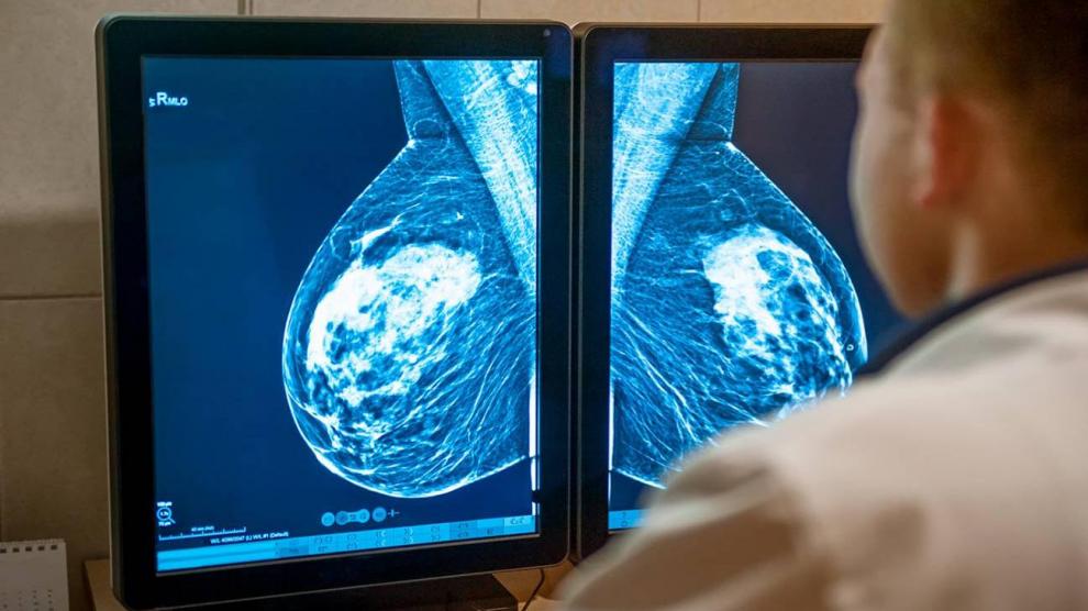 Los resultados del nuevo estudio cambian la práctica clínica en el cáncer de mama más frecuente y evitará la quimioterapia a miles de pacientes.