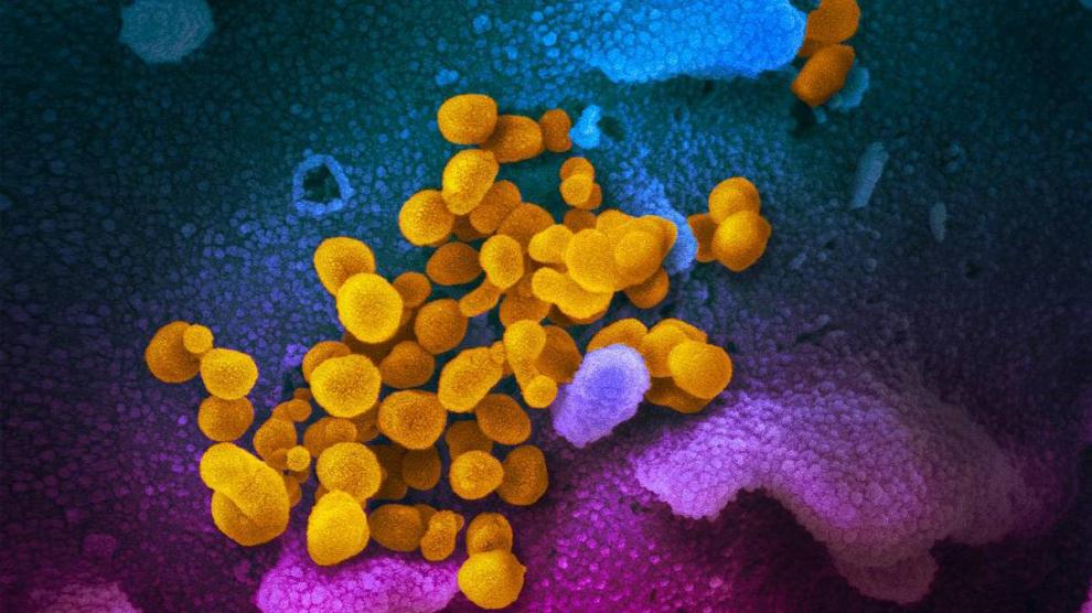 Virus SARS-CoV-2 (en amarillo) emergiendo de células (rosadas y azules) cultivadas en el laboratorio. Imagen vista con el microscopio electrónico de barrido y virus aislados de un paciente en EE. UU.