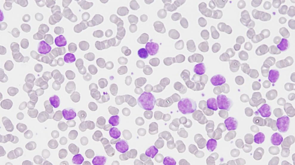Imagen de una citología de leucemia linfática crónica.
