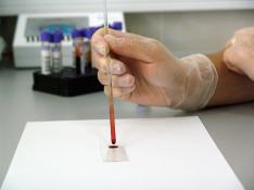 Un nuevo test sanguíneo mejora la detección de recurrencias del cáncer de colon