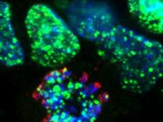 Célula tumoral tratada con los inhibidores de ATR desarrollados en el CNIO. En verde, las roturas en el ADN de las células generadas por el tratamiento. En azul, los cromosomas