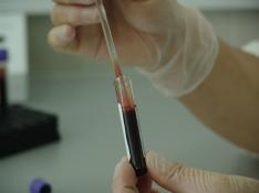 Una proteína en sangre, clave para el diagnóstico y seguimiento del tratamiento del VIH