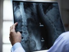 El 28% de los hombres estudiados de 35 a 50 años de edad corre riesgo de osteoporosis.