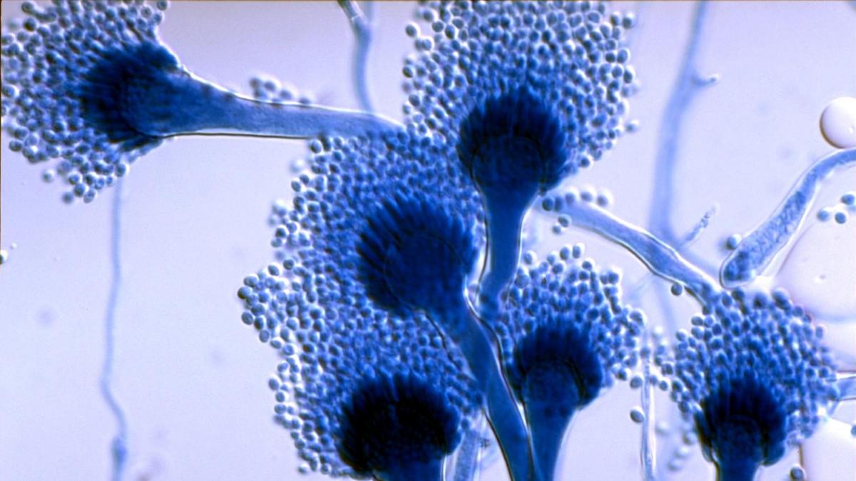 Aspergilosis y hongos en los pulmones  Mejor con Salud