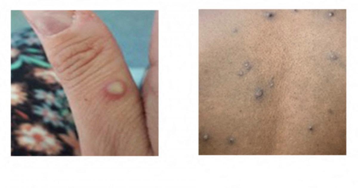 Aragão confirma dois novos casos de varíola, somando um total de 47